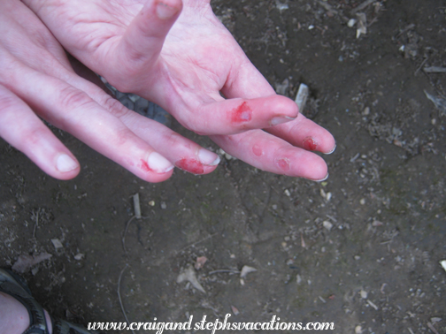 Steph's injured fingers